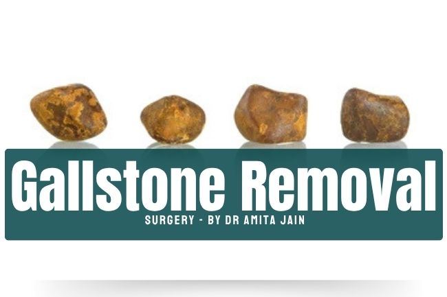gallstone removal doctor surgeon Dr Amita Jain
